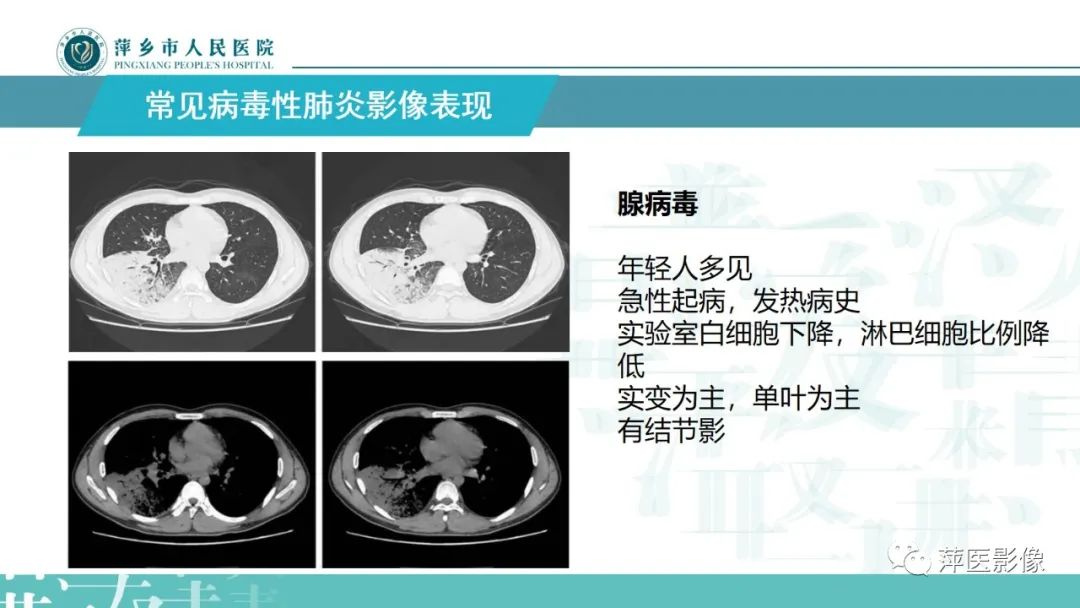 影像PPT - 【PPT】病毒性肺炎解剖、病理和影像诊断-14