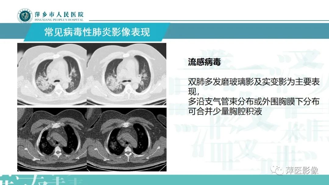 影像PPT - 【PPT】病毒性肺炎解剖、病理和影像诊断-15