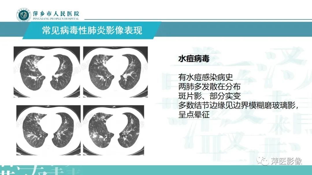影像PPT - 【PPT】病毒性肺炎解剖、病理和影像诊断-16
