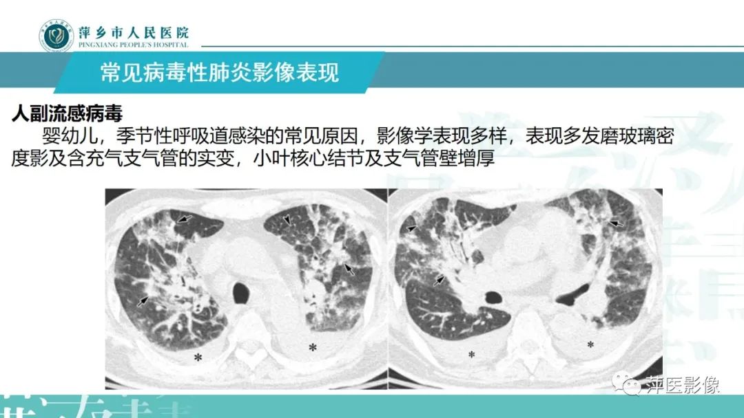 影像PPT - 【PPT】病毒性肺炎解剖、病理和影像诊断-17