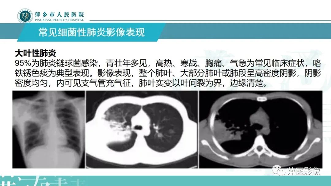 影像PPT - 【PPT】病毒性肺炎解剖、病理和影像诊断-18