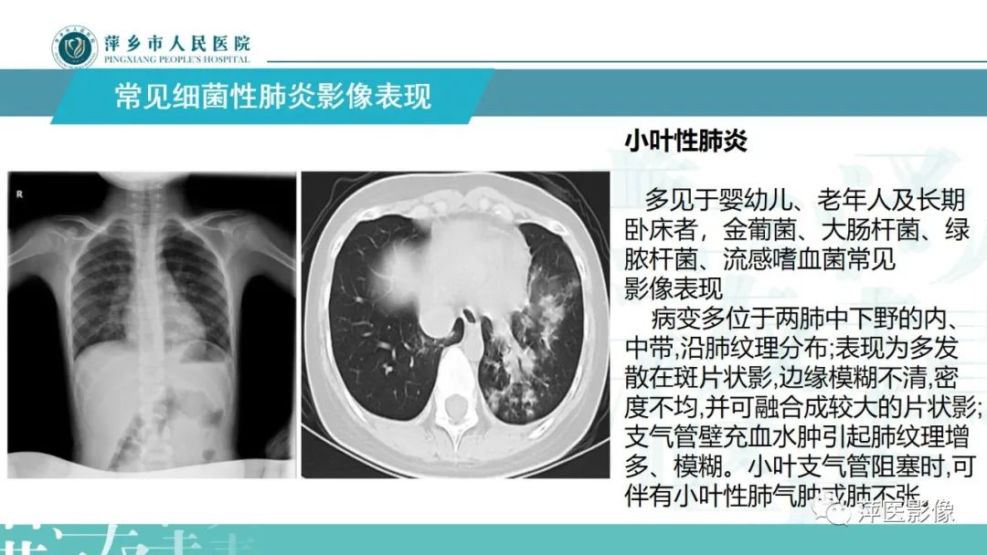 影像PPT - 【PPT】病毒性肺炎解剖、病理和影像诊断-19
