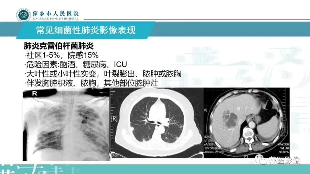 影像PPT - 【PPT】病毒性肺炎解剖、病理和影像诊断-20