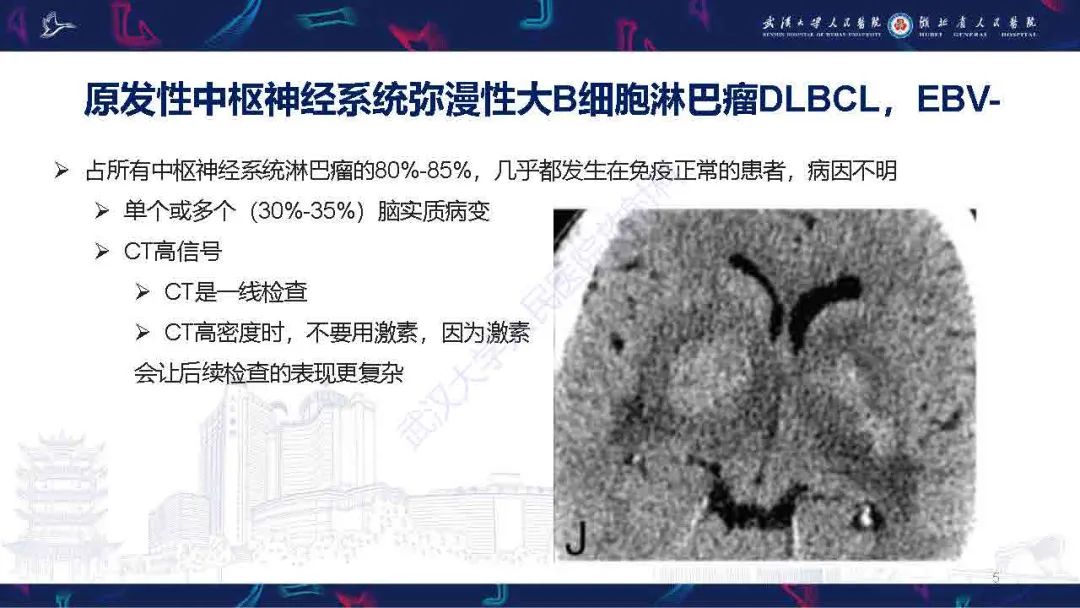 影像PPT - 【PPT】中枢神经系统淋巴瘤WHO分类更新及影像诊断-5
