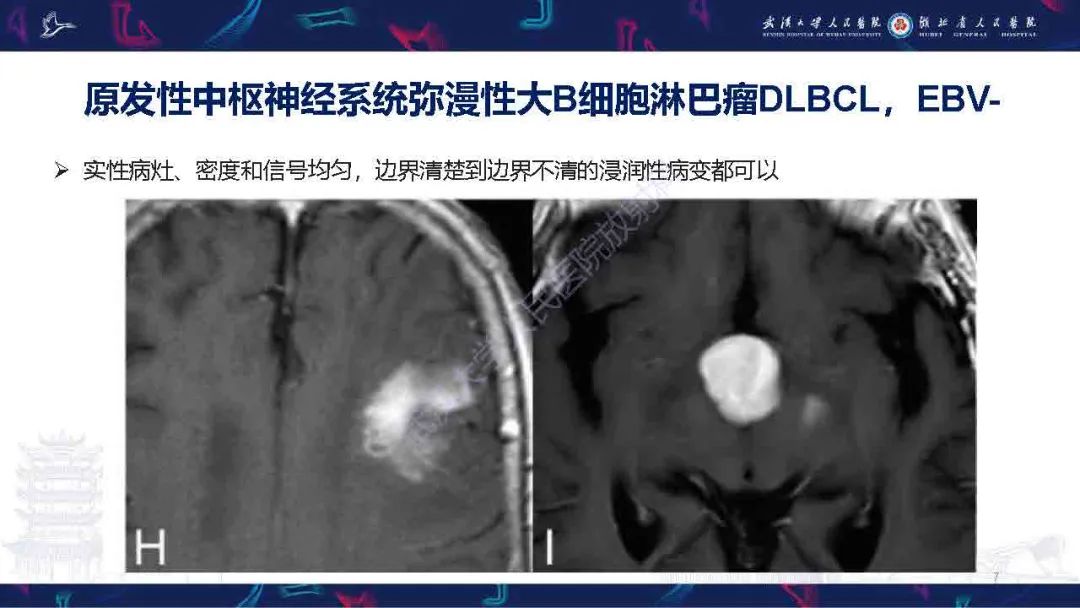 影像PPT - 【PPT】中枢神经系统淋巴瘤WHO分类更新及影像诊断-7