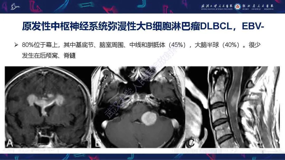 影像PPT - 【PPT】中枢神经系统淋巴瘤WHO分类更新及影像诊断-6