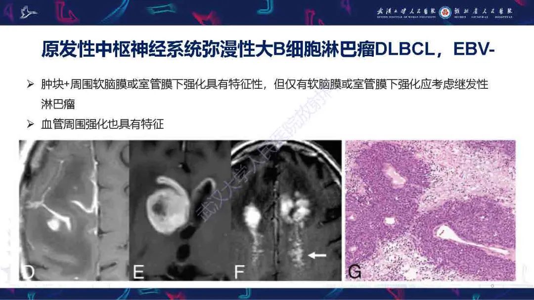 影像PPT - 【PPT】中枢神经系统淋巴瘤WHO分类更新及影像诊断-8
