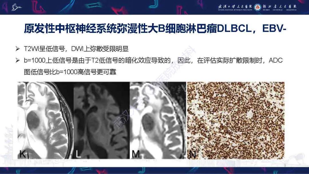 影像PPT - 【PPT】中枢神经系统淋巴瘤WHO分类更新及影像诊断-9