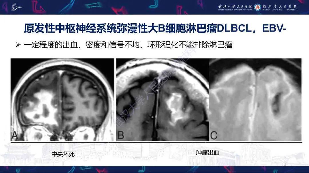 影像PPT - 【PPT】中枢神经系统淋巴瘤WHO分类更新及影像诊断-10