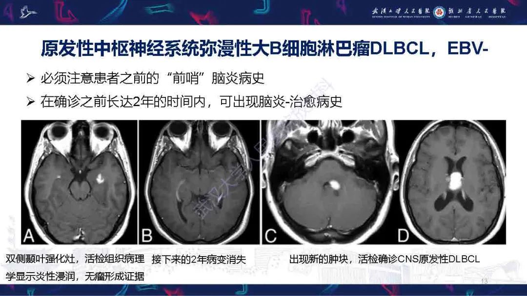 影像PPT - 【PPT】中枢神经系统淋巴瘤WHO分类更新及影像诊断-13