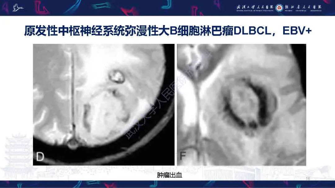影像PPT - 【PPT】中枢神经系统淋巴瘤WHO分类更新及影像诊断-16