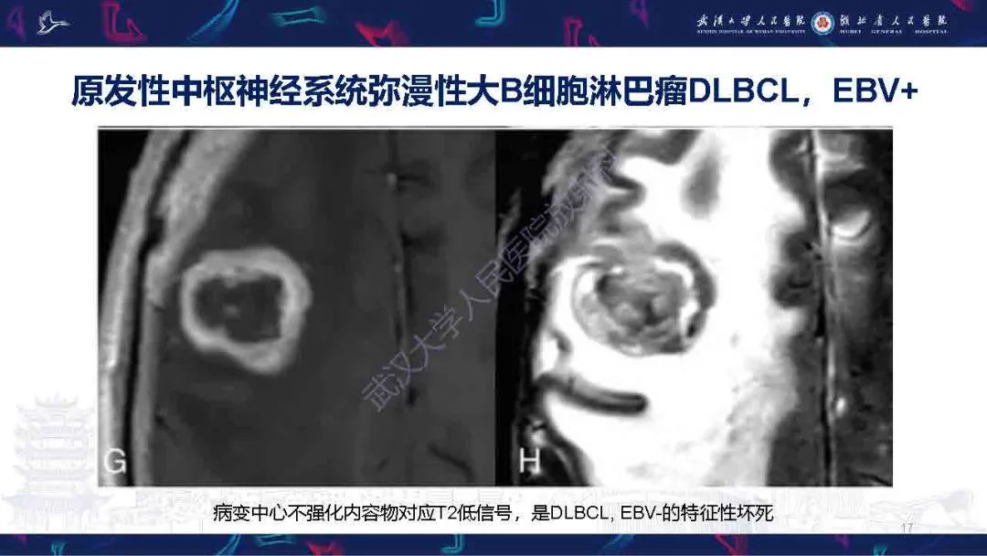 影像PPT - 【PPT】中枢神经系统淋巴瘤WHO分类更新及影像诊断-17