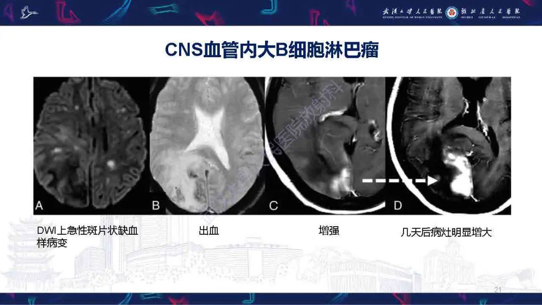 影像PPT - 【PPT】中枢神经系统淋巴瘤WHO分类更新及影像诊断-21