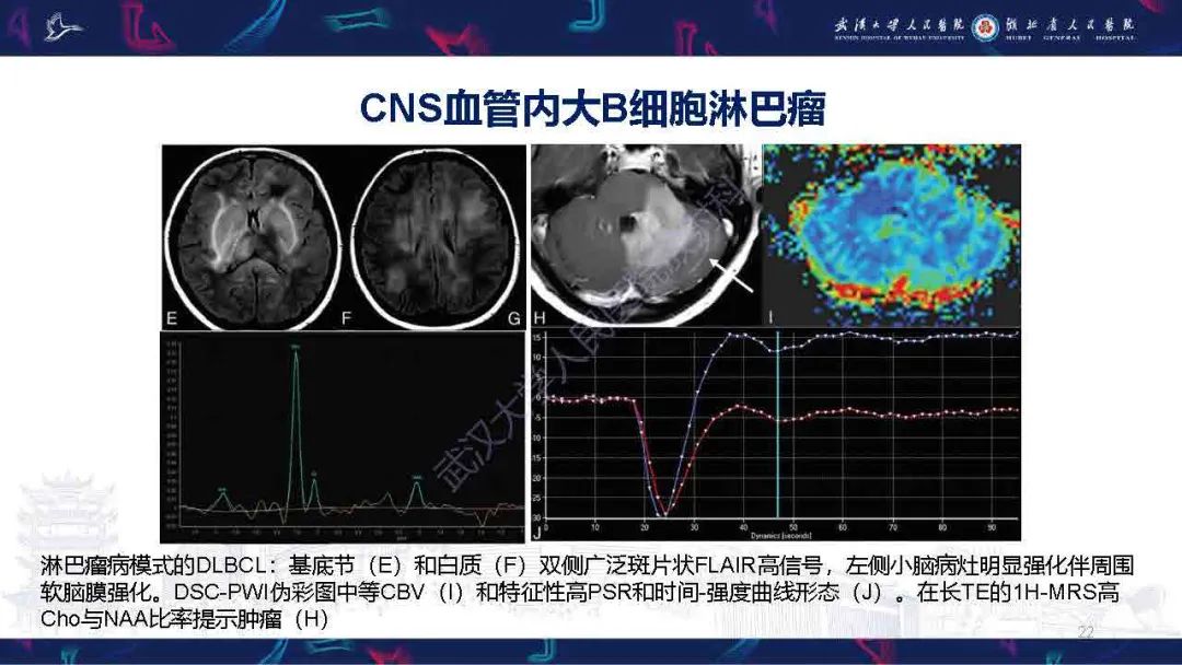 影像PPT - 【PPT】中枢神经系统淋巴瘤WHO分类更新及影像诊断-22