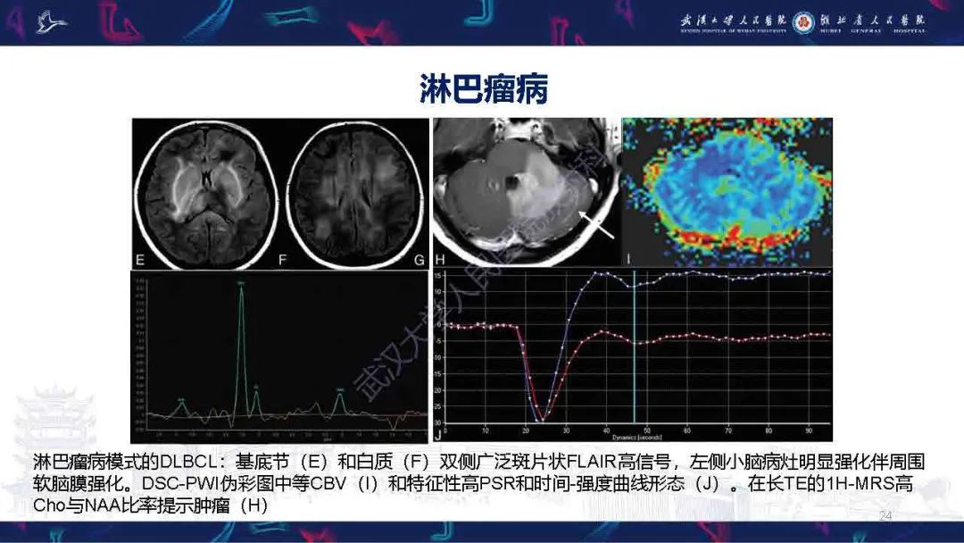 影像PPT - 【PPT】中枢神经系统淋巴瘤WHO分类更新及影像诊断-24