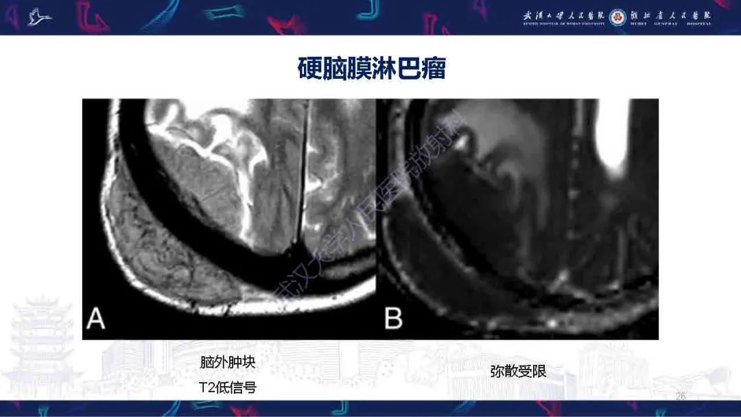 影像PPT - 【PPT】中枢神经系统淋巴瘤WHO分类更新及影像诊断-26