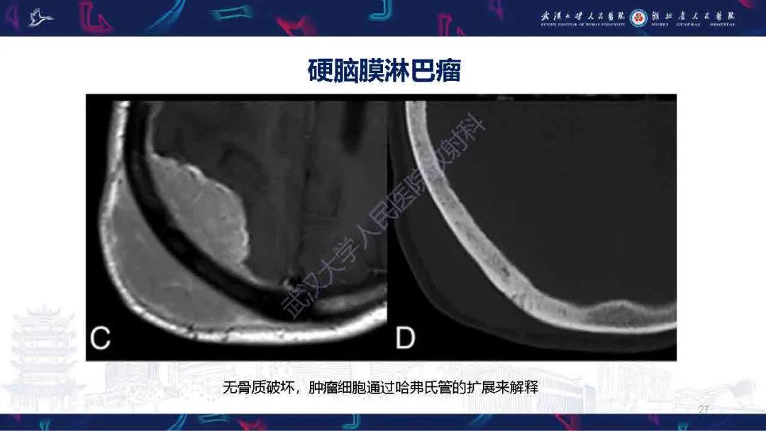 影像PPT - 【PPT】中枢神经系统淋巴瘤WHO分类更新及影像诊断-27