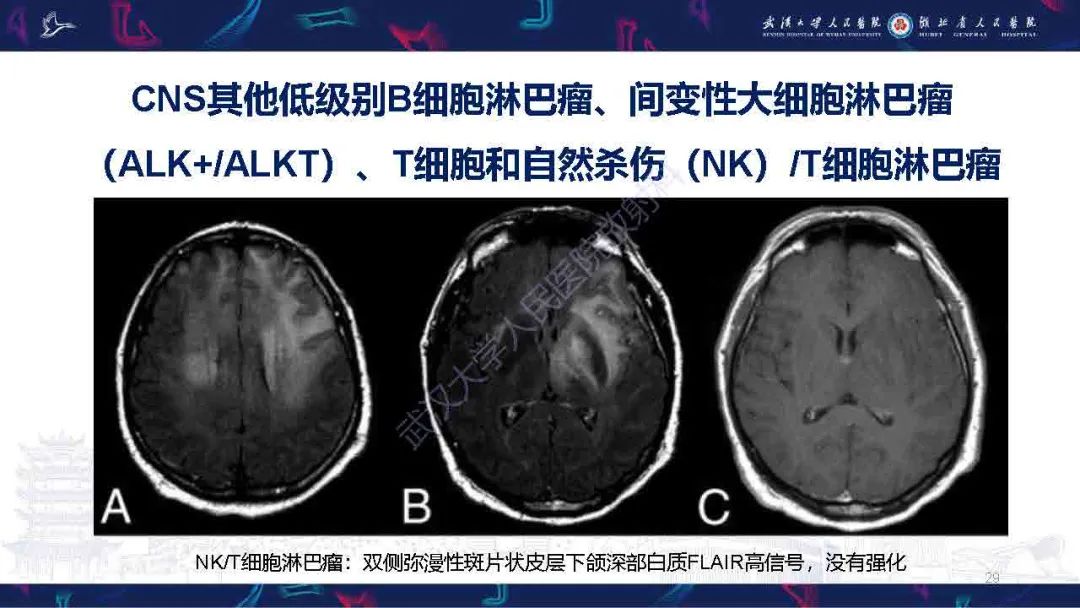影像PPT - 【PPT】中枢神经系统淋巴瘤WHO分类更新及影像诊断-29