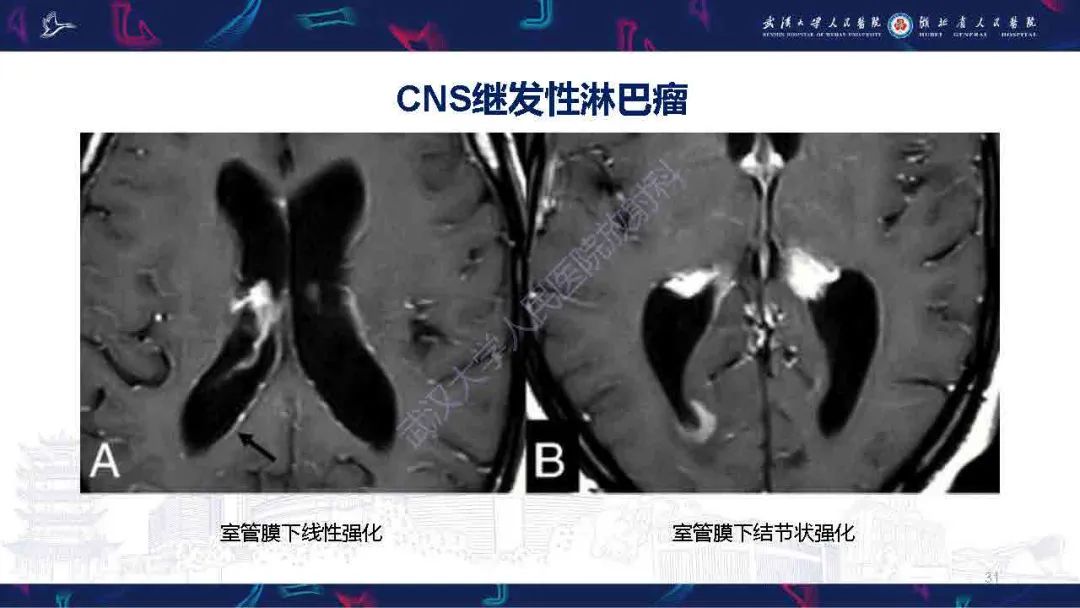 影像PPT - 【PPT】中枢神经系统淋巴瘤WHO分类更新及影像诊断-31