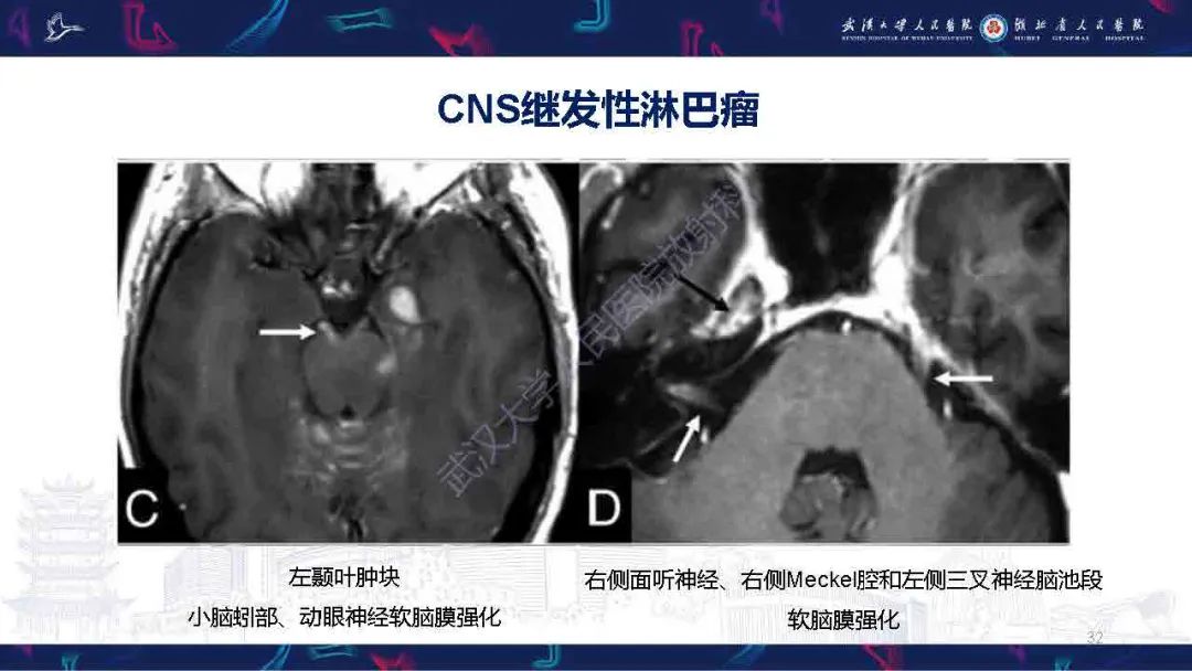影像PPT - 【PPT】中枢神经系统淋巴瘤WHO分类更新及影像诊断-32