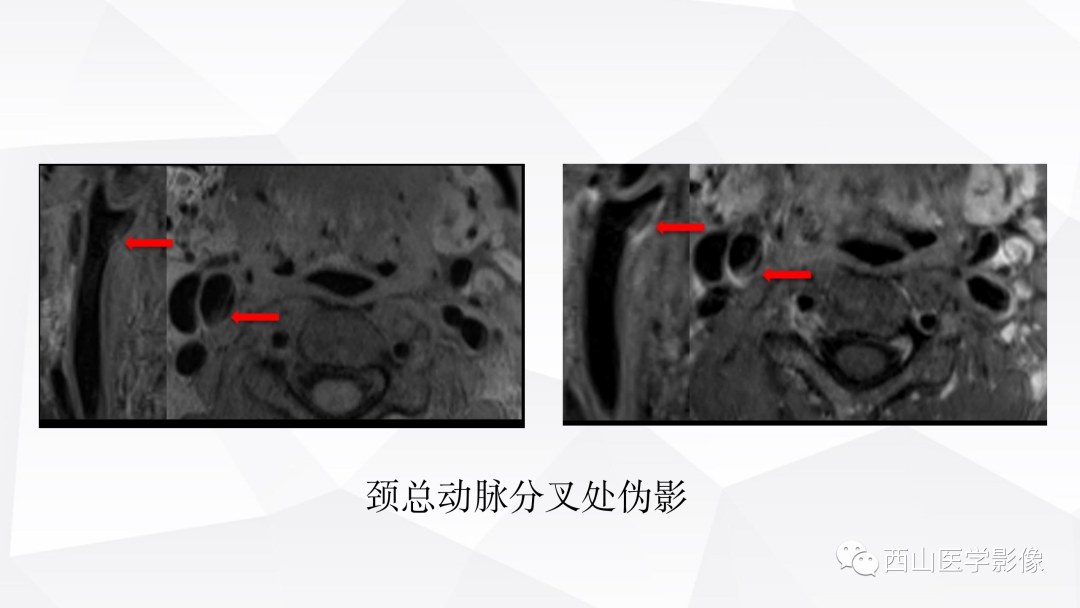 影像PPT - 【PPT】头颈部动脉磁共振高分辨血管壁成像报告书写规范及病例分析-8