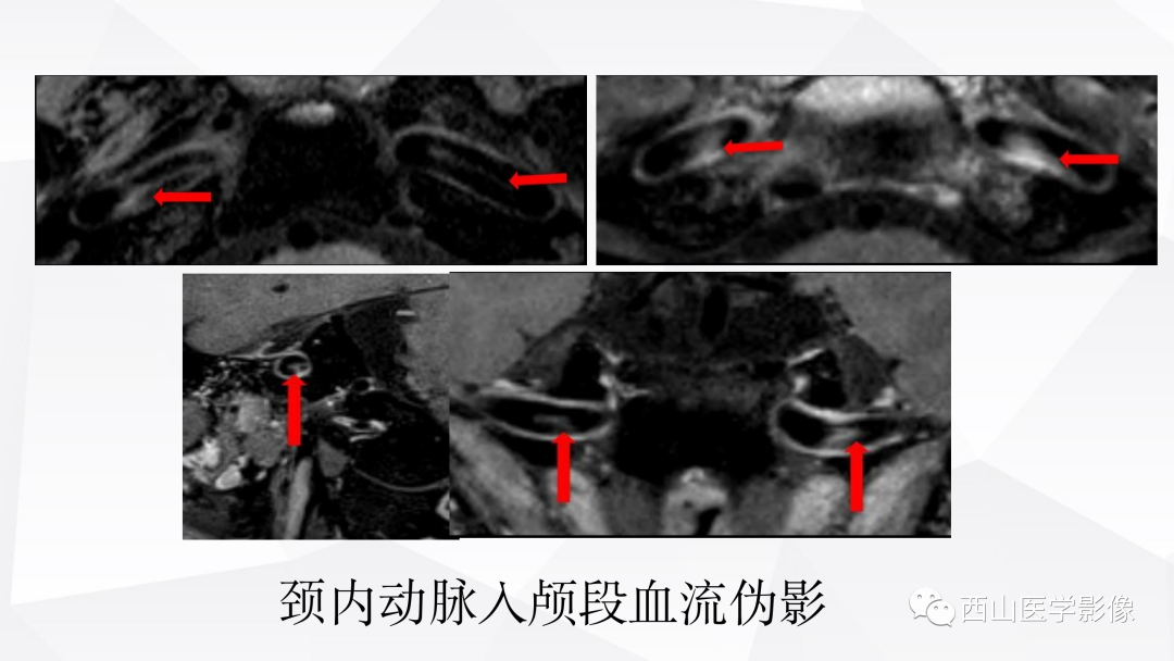 影像PPT - 【PPT】头颈部动脉磁共振高分辨血管壁成像报告书写规范及病例分析-9