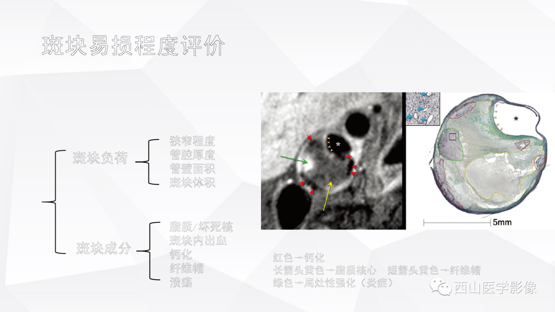 影像PPT - 【PPT】头颈部动脉磁共振高分辨血管壁成像报告书写规范及病例分析-15
