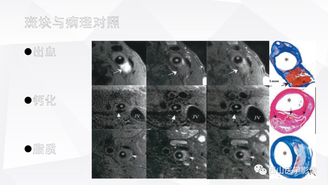 影像PPT - 【PPT】头颈部动脉磁共振高分辨血管壁成像报告书写规范及病例分析-16