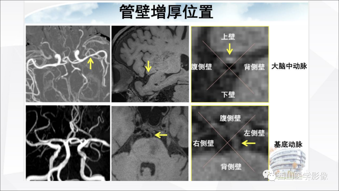 影像PPT - 【PPT】头颈部动脉磁共振高分辨血管壁成像报告书写规范及病例分析-22