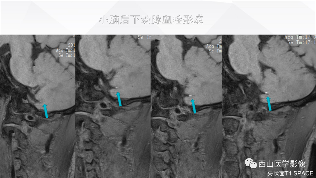 影像PPT - 【PPT】头颈部动脉磁共振高分辨血管壁成像报告书写规范及病例分析-27