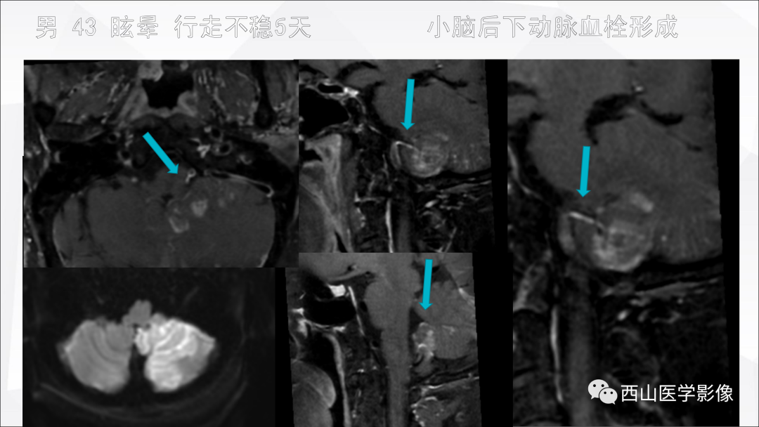 影像PPT - 【PPT】头颈部动脉磁共振高分辨血管壁成像报告书写规范及病例分析-28