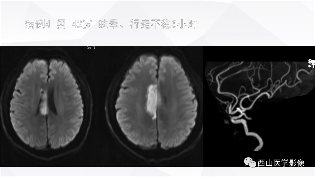 影像PPT - 【PPT】头颈部动脉磁共振高分辨血管壁成像报告书写规范及病例分析-29