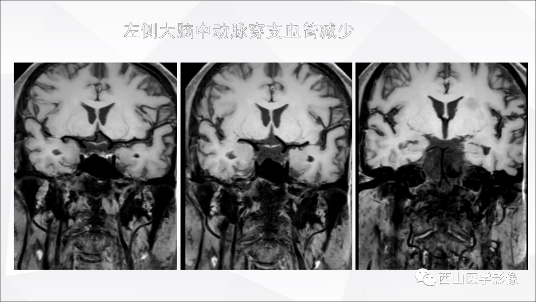 影像PPT - 【PPT】头颈部动脉磁共振高分辨血管壁成像报告书写规范及病例分析-32
