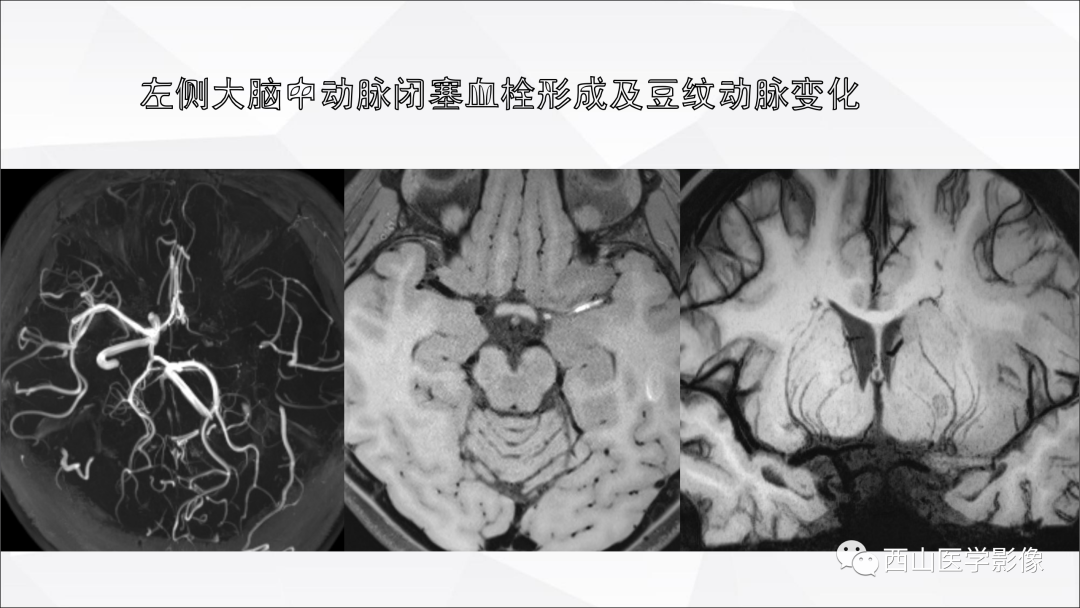 影像PPT - 【PPT】头颈部动脉磁共振高分辨血管壁成像报告书写规范及病例分析-33