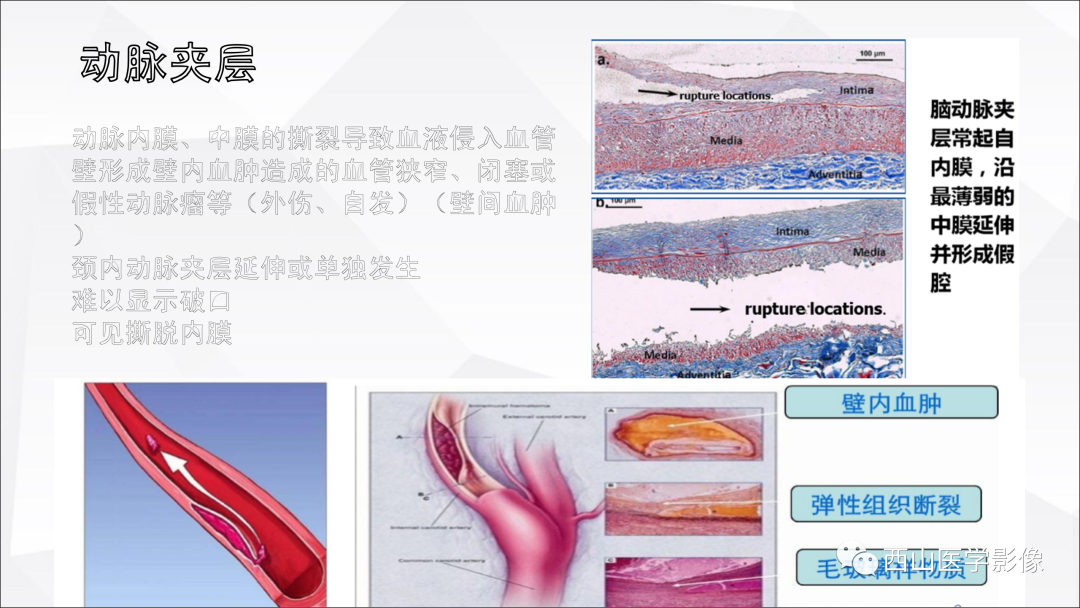 影像PPT - 【PPT】头颈部动脉磁共振高分辨血管壁成像报告书写规范及病例分析-35