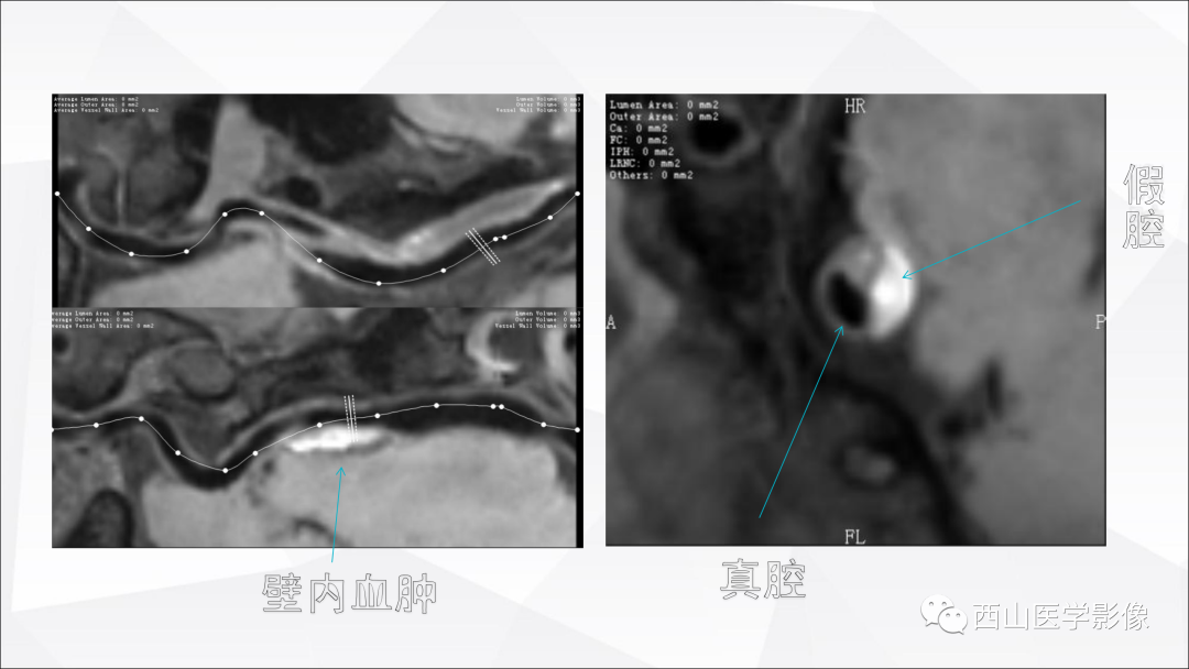 影像PPT - 【PPT】头颈部动脉磁共振高分辨血管壁成像报告书写规范及病例分析-41