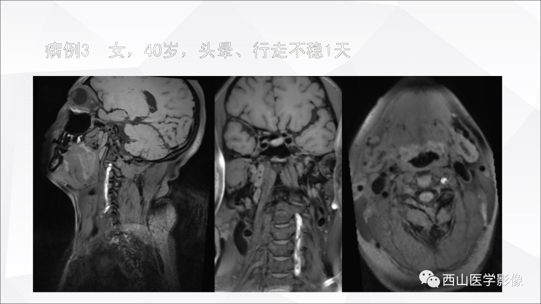 影像PPT - 【PPT】头颈部动脉磁共振高分辨血管壁成像报告书写规范及病例分析-42