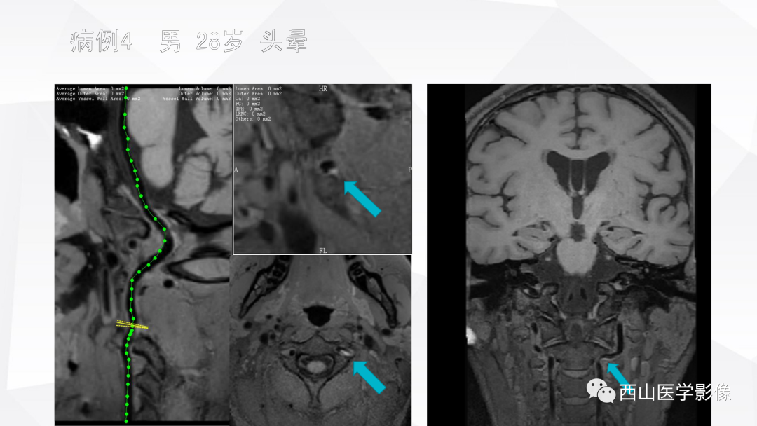影像PPT - 【PPT】头颈部动脉磁共振高分辨血管壁成像报告书写规范及病例分析-43