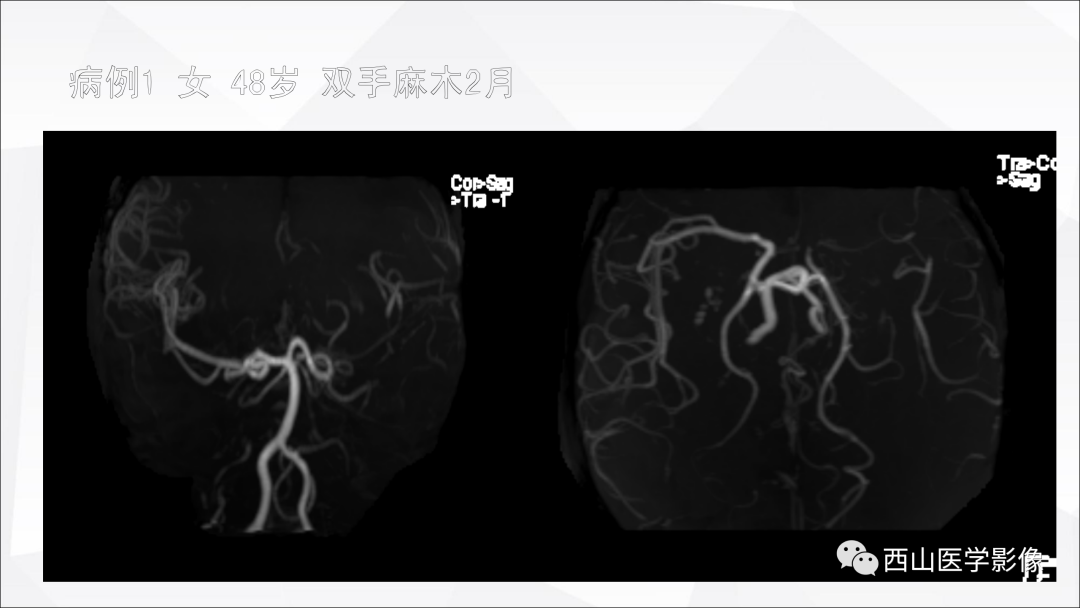 影像PPT - 【PPT】头颈部动脉磁共振高分辨血管壁成像报告书写规范及病例分析-48