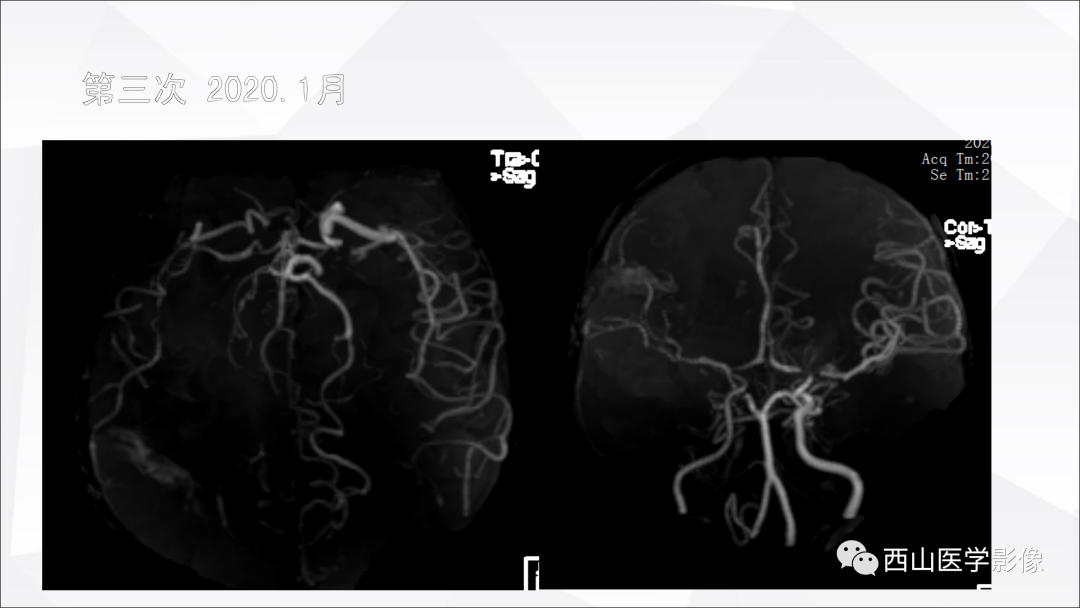 影像PPT - 【PPT】头颈部动脉磁共振高分辨血管壁成像报告书写规范及病例分析-56