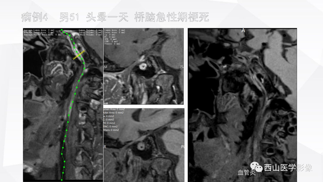 影像PPT - 【PPT】头颈部动脉磁共振高分辨血管壁成像报告书写规范及病例分析-58