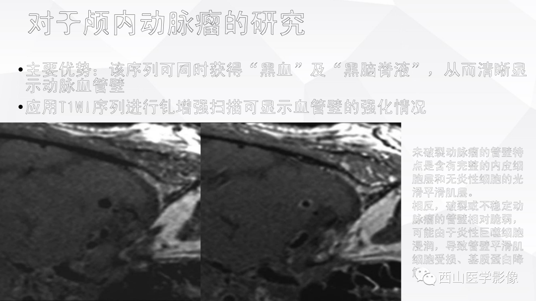 影像PPT - 【PPT】头颈部动脉磁共振高分辨血管壁成像报告书写规范及病例分析-61