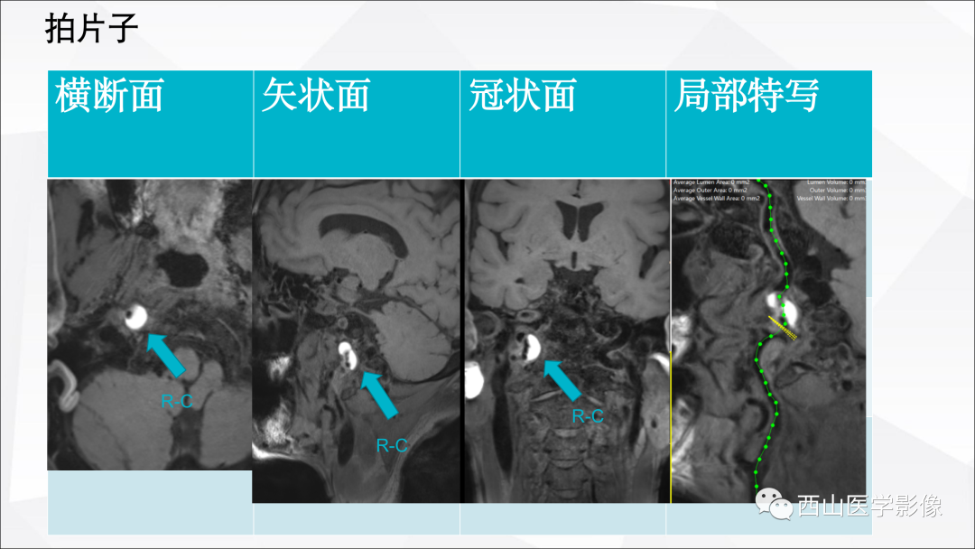 影像PPT - 【PPT】头颈部动脉磁共振高分辨血管壁成像报告书写规范及病例分析-68