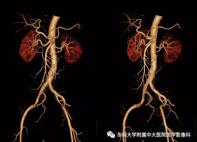 影像PPT - 【PPT】肾动脉常见病变-3