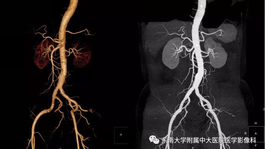 影像PPT - 【PPT】肾动脉常见病变-5