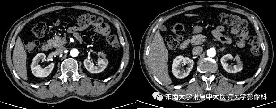影像PPT - 【PPT】肾动脉常见病变-4