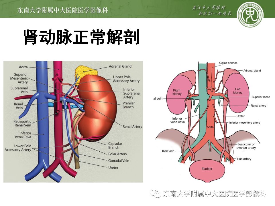 影像PPT - 【PPT】肾动脉常见病变-10