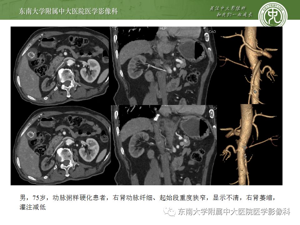 影像PPT - 【PPT】肾动脉常见病变-12