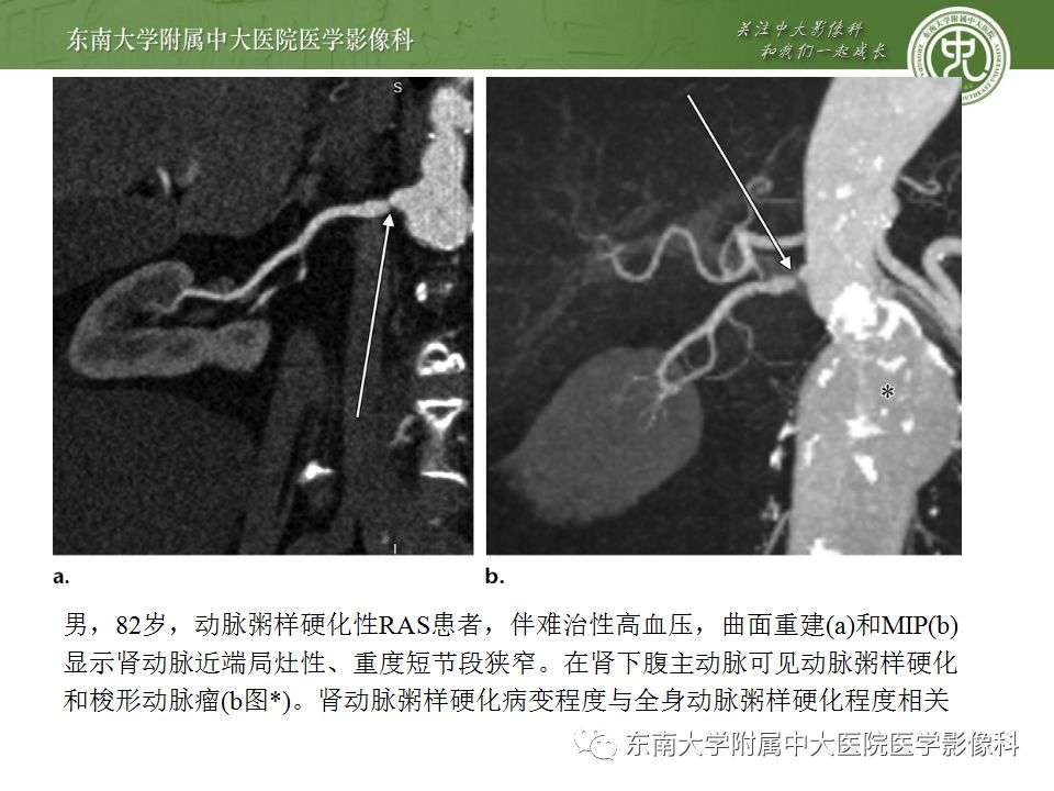 影像PPT - 【PPT】肾动脉常见病变-13