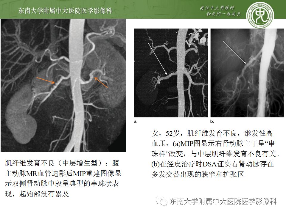 影像PPT - 【PPT】肾动脉常见病变-17